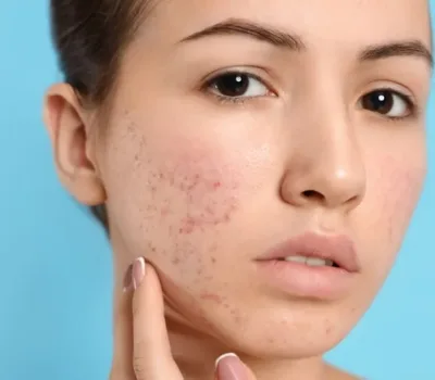 Treatment-for-Acne-Scars-in-Oakbrook-Terrace-1-1024x678