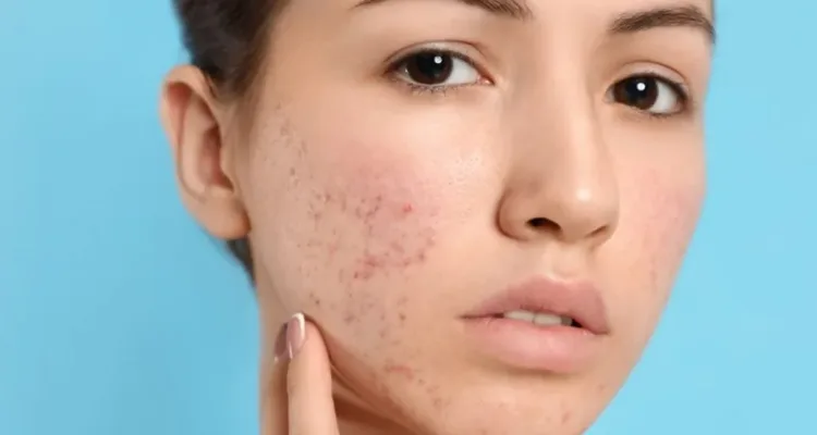 Treatment-for-Acne-Scars-in-Oakbrook-Terrace-1-1024x678